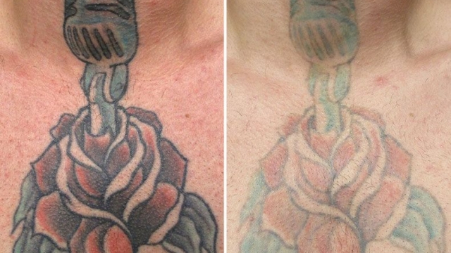 The Tattoo Laser Treatment – How Good Does It Work?