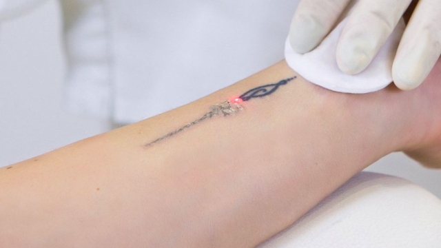The Latest Thing In Laser Tattoo Removal